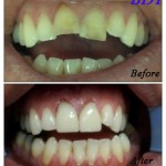 Dental Veneer