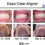 Essix Case - M.S.
