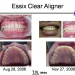 Essix Case - T.N.