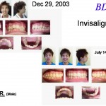Invisalign Case
