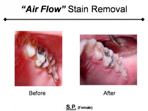 AirFlowExample1 Air flow stain removal