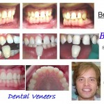 Veneer Case - M