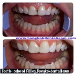 Tooth-colored filling