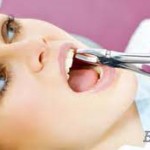 Instruction after surgery Dental Extraction